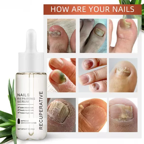 7 días de crecimiento y fortalecimiento de uñas suero 0.7 fl oz solución suavizante de onicomicosis aceite de tratamiento de uñas para uñas descoloridas y dañadas